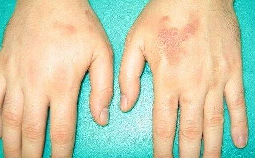 Hand joint pain may be a symptom of parasites