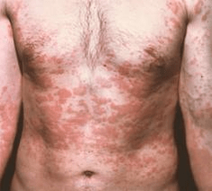 Problematic skin is a symptom of parasite presence