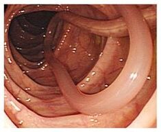 parasites in human body