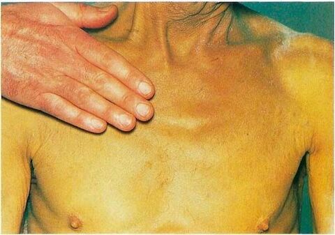 Jaundice due to internal parasites