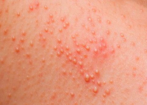 If the body is affected by parasites, skin allergies will appear