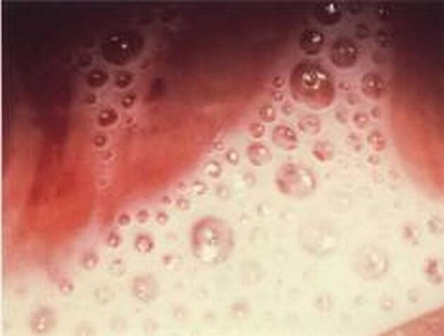 Bubble discharge of protozoan parasites