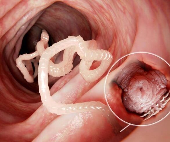 Photos of worms in the human intestine 2