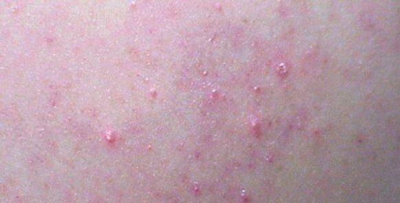 Skin rashes on the body may be a sign of helminthiasis